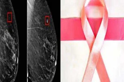अमेरिका के शोधकर्ताओं ने की स्तन कैंसर जोखिम से जुड़े ऊतक परिवर्तनों की पहचान