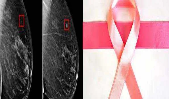 अमेरिका के शोधकर्ताओं ने की स्तन कैंसर जोखिम से जुड़े ऊतक परिवर्तनों की पहचान